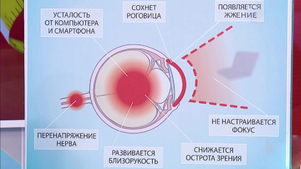 Перенапряжение зрительного анализатора. Компьютерный зрительный синдром. Компьютерный синдром глаз симптомы. Синдром компьютерного зрения. Причины компьютерного зрительного синдрома.